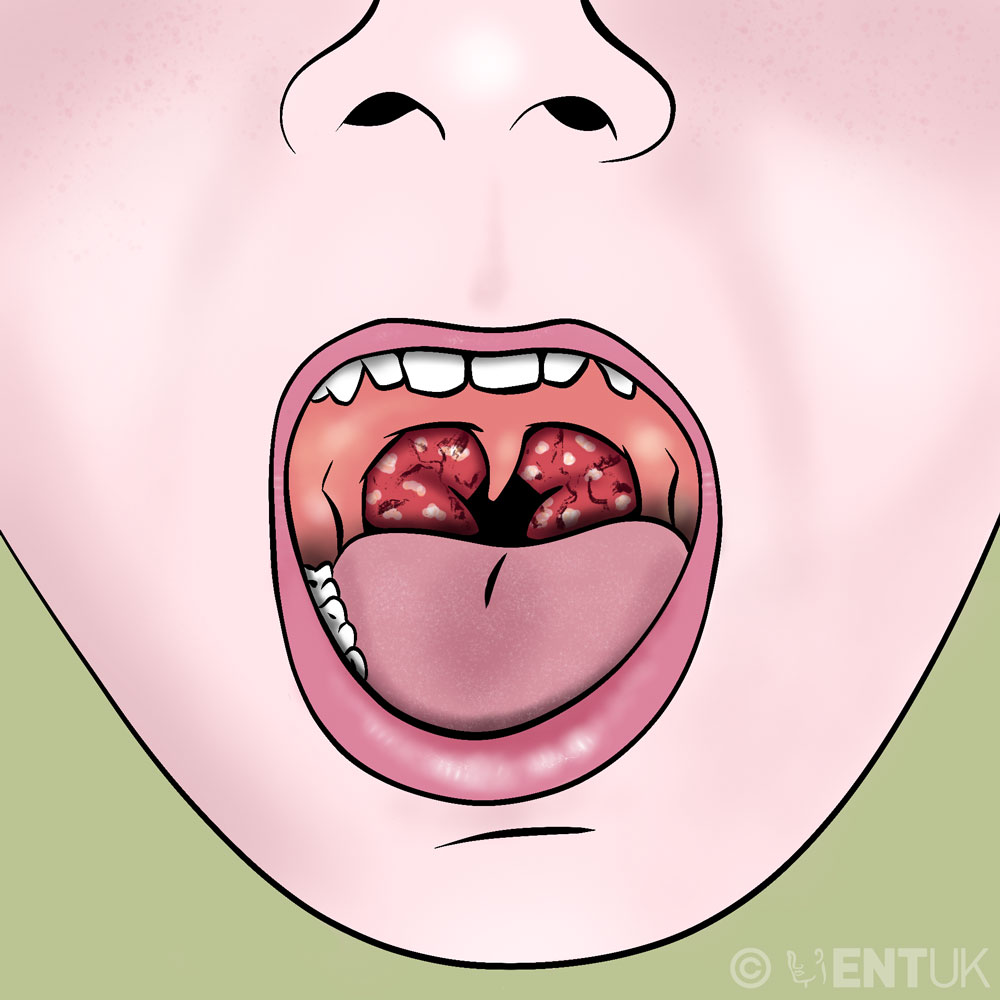 Child face with open mouth showing large, infected tonsils, red and covered in white spots or pus