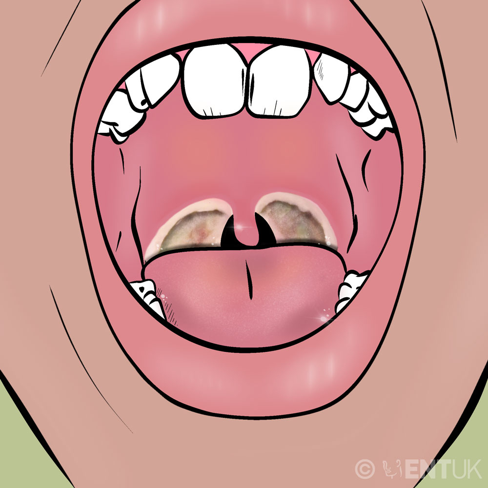 Child with open mouth showing after tonsillectomy, the back of the throat will be covered with a white coating.