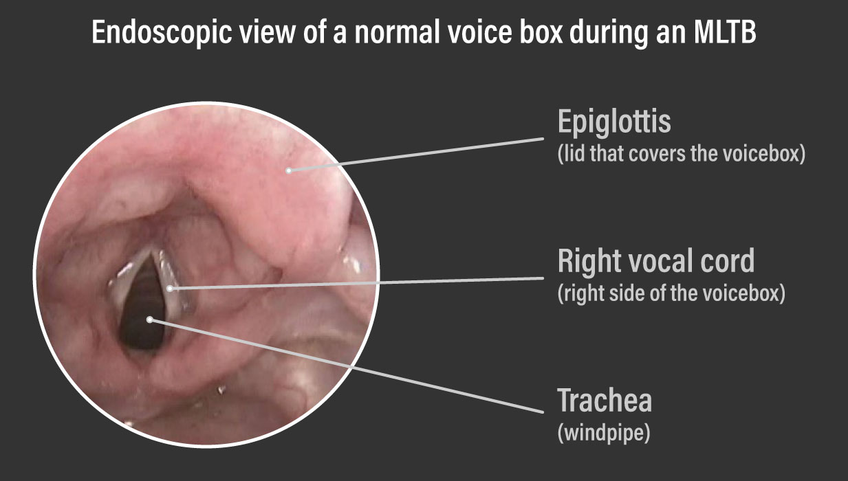 Endoscopic view of a normal voice box during an MLTB