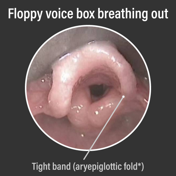 Endoscopic view of a floppy voice box on breathing out