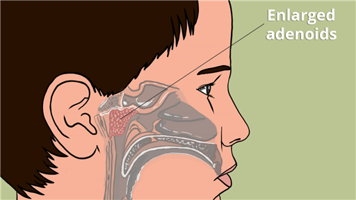 Adenoid Surgery