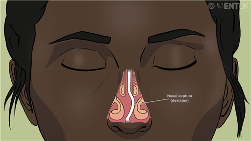 Septal surgery