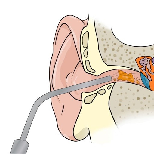 Ear microsuction