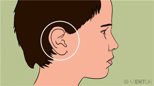 Grommets - A decision-making aid for parents