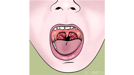 Helping you decide about tonsil surgery for your child