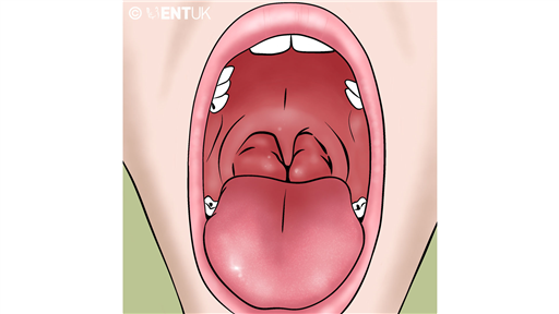 Intracapsular tonsillectomy for children