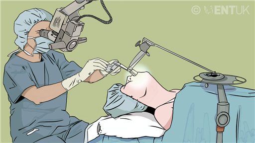 Microlaryngoscopy: an operation on your voicebox