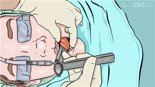 Rigid pharyngoscopy and upper oesophagoscopy