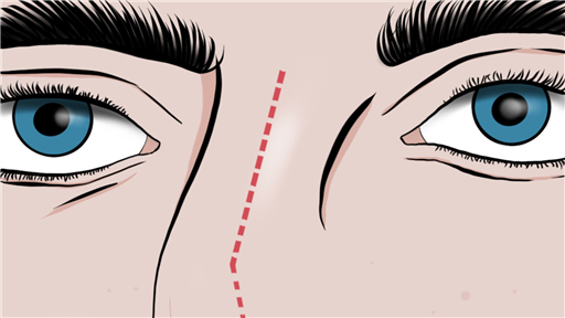 Septorhinoplasty