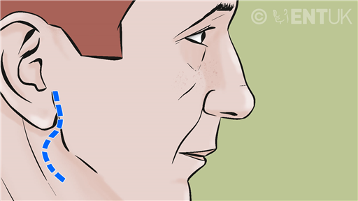 Parotidectomy - Surgery to remove a lump