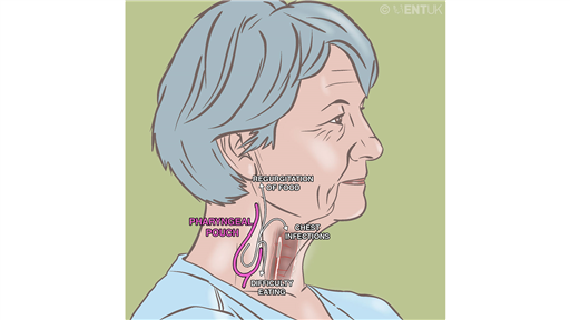 Pharyngeal pouch surgery