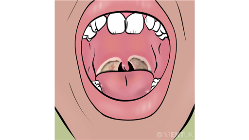 After your child’s tonsil surgery: tips for parents