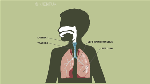 MLTB - Micro-laryngo-tracheo-bronchoscopy