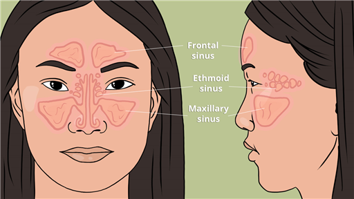 Sinus surgery for  chronic rhinosinusitis with nasal polyps