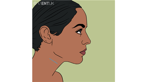 Submandibular gland excision - Surgery for infection and/or recurrent blockage