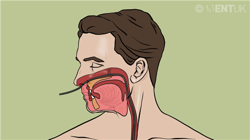 Trans-nasal oesophagoscopy (TNO)