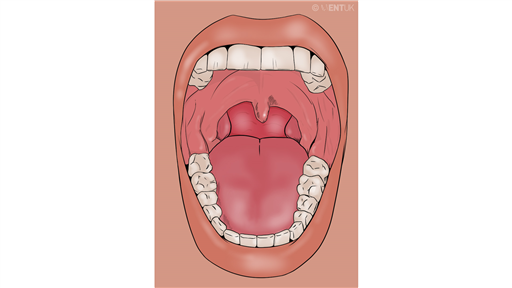 Tonsillectomy (taking out your tonsils) because of repeated infections