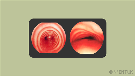 Tracheomalacia in children