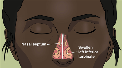 Turbinoplasty or surgery to the inferior turbinates