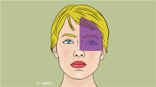 Vestibular migraine